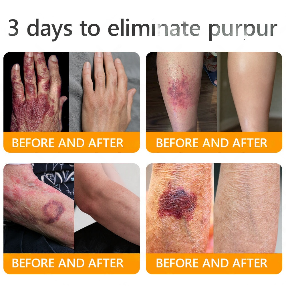 EQVP® 𝘽𝙀𝙀 𝙑𝙀𝙉𝙊𝙈 𝑺𝒌𝒊𝒏 𝑹𝒆𝒔𝒕𝒐𝒓𝒂𝒕𝒊𝒐𝒏 𝑪𝒓𝒆𝒂𝒎 –🌵 Anti-aging,Hydrating, Skin Repair, Even Tone, Acne and Dark Spot Treatment, Wart and Mole Removal, Psoriasis Relief